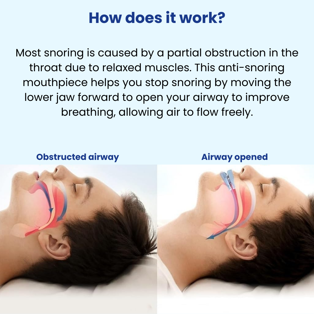 QuietSleep™ Anti-Snoring Mouthpiece